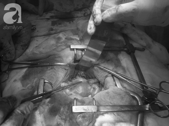 Cô gái trẻ phát hiện bị ung thư tử cung khi mới 26 tuổi: Lời cảnh báo cho các chị em hay bị ra huyết âm đạo bất thường