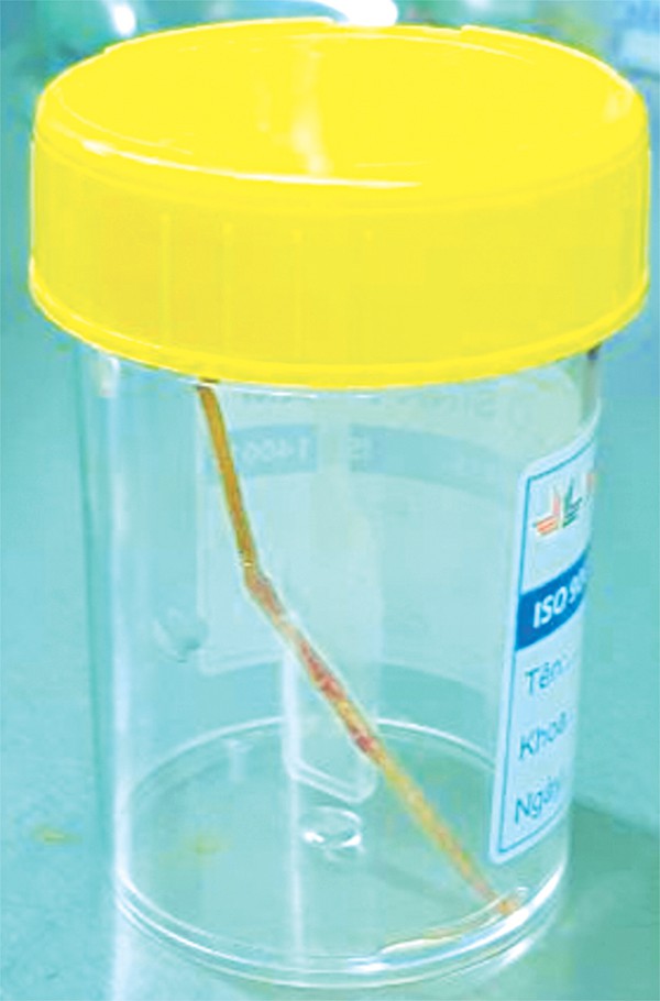 Hiểm họa từ những chiếc tăm