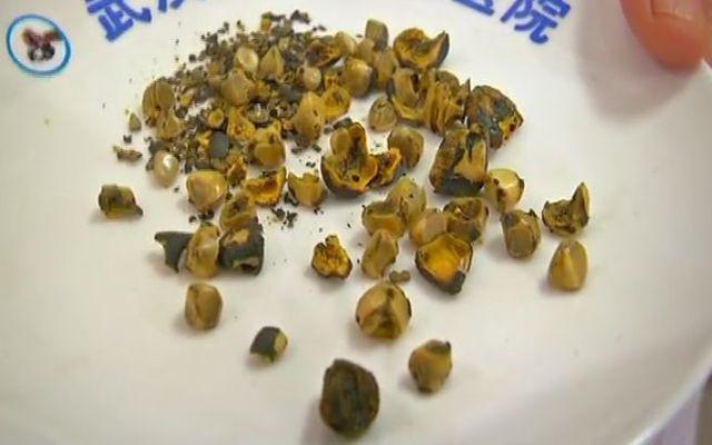 Tưởng không ăn thịt sẽ tốt cho sức khỏe, người phụ nữ phải trả giá đắt