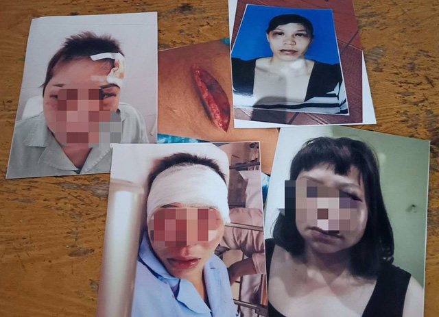 Nữ hộ lý bệnh viện bị chồng bạo hành giờ ra sao?