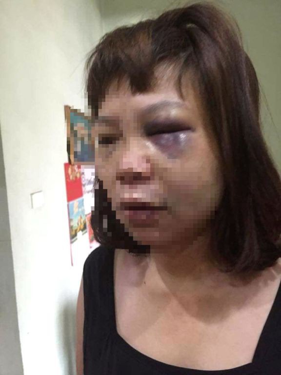 Nữ hộ lý bệnh viện bị chồng bạo hành giờ ra sao?