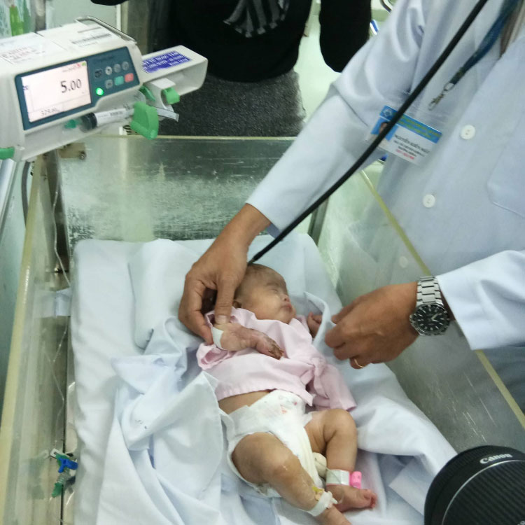 Cứu bé sơ sinh bị hoại tử lộ xương bàn tay