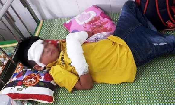 Nghệ An: Điện thoại đang sạc phát nổ, cháu bé 7 tuổi bị dập nát tay