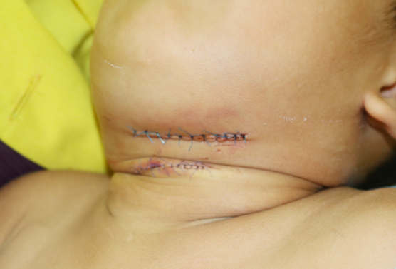 Chó nhà nuôi bất ngờ tấn công, cắn nham nhở cổ em bé 4 tuổi