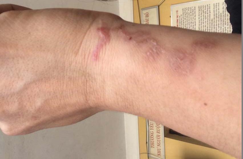 Thường xuyên trồng, chăm hoa, người phụ nữ hốt hoảng vì ho ra đờm toàn sinh vật lạ