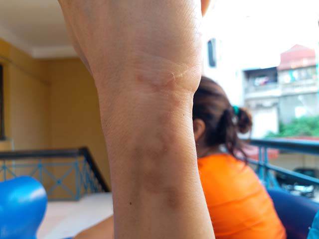 Thường xuyên trồng, chăm hoa, người phụ nữ hốt hoảng vì ho ra đờm toàn sinh vật lạ