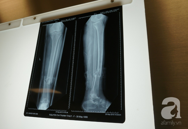 Nhất quyết không cho truyền máu người lạ, người phụ nữ ở TP.HCM suýt mất chân vì nhiều bệnh viện từ chối mổ