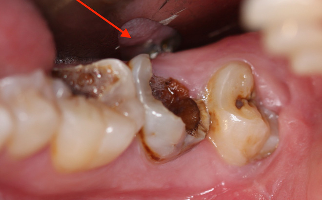Chuyện gì sẽ xảy ra nếu bạn có một chiếc răng sâu và không chịu chữa trị ngay?