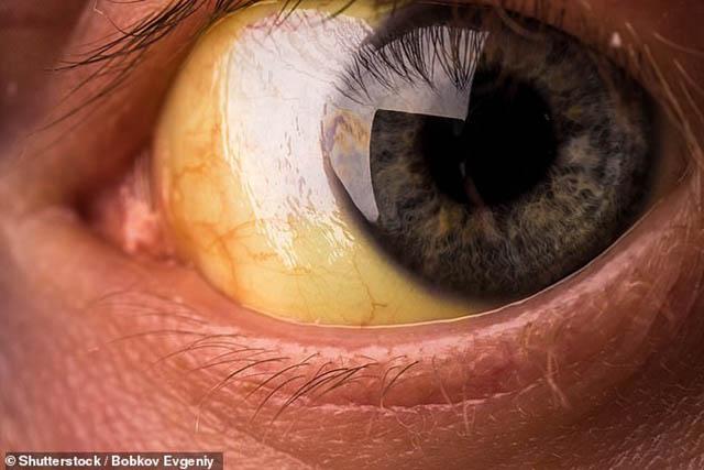 Tưởng là dấu hiệu bình thường của cơ thể, hóa ra lại là bệnh rất nguy hiểm