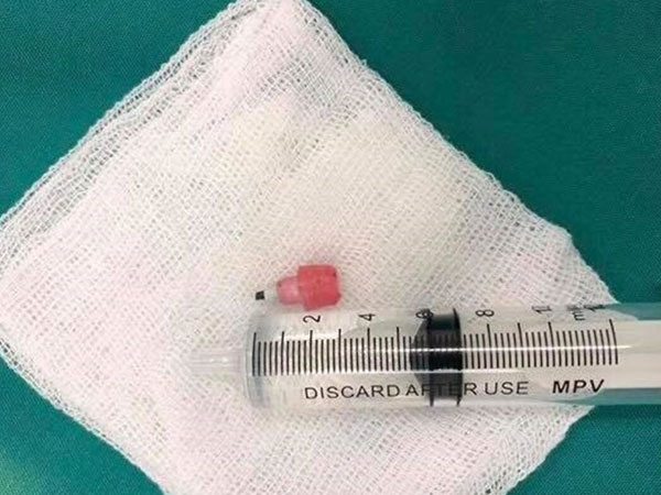 Bé gái 6 tuổi nguy kịch vì nuốt đầu mẩu bút chì