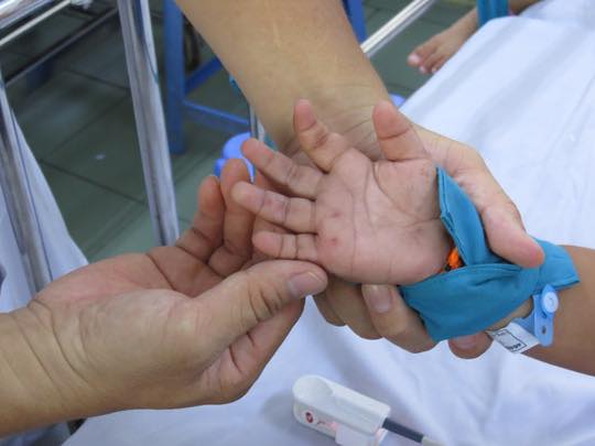 Các bệnh viện quay cuồng với dịch bệnh tay chân miệng