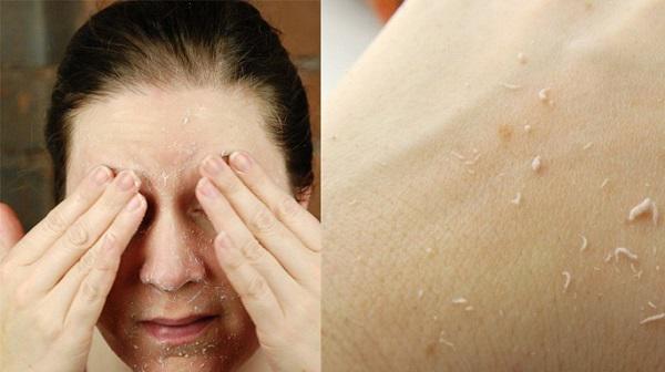 Để mặt không khô sần, bạn nhất định phải nằm lòng 7 bí quyết chăm sóc da mùa đông này