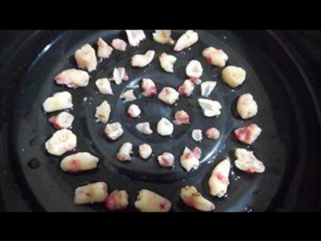 Bé trai 2 tuổi có 50 chiếc răng, 7 năm sau nhìn phim chụp khoang miệng ai cũng sững sờ