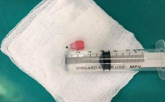 Ngồi học nuốt phải đầu bút chì, bé 6 tuổi toàn thân tím tái ngừng thở