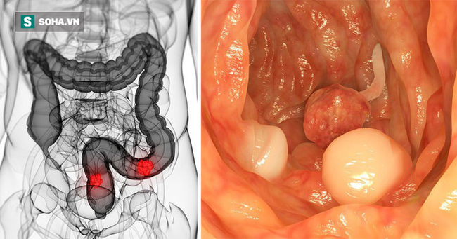 5 dấu hiệu điển hình cảnh báo khối u ung thư đại trực tràng đang phát triển thần tốc