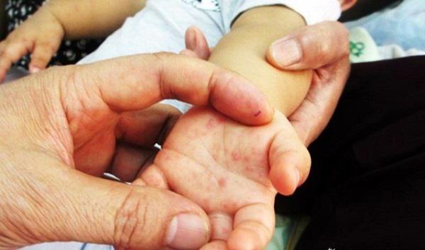 Để trẻ không tử vong khi mắc tay chân miệng, Bộ Y tế khuyến cáo 6 điều phải làm ngay