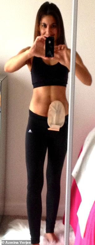 Cứ nghĩ chỉ là biểu hiện bị căng thẳng trong công việc, không ngờ lại do bệnh ung thư: Người phụ nữ phải phẫu thuật cắt ruột để sống sót