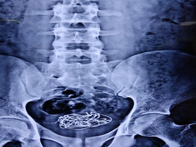 Nhét dây điện vào của quý, lọt đến tận bàng quang