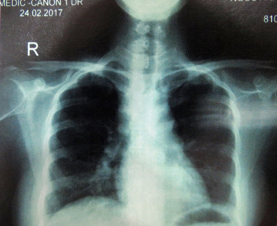 Tưởng nổi mụn lạ, cô gái khổ vì bệnh siêu giả dạng