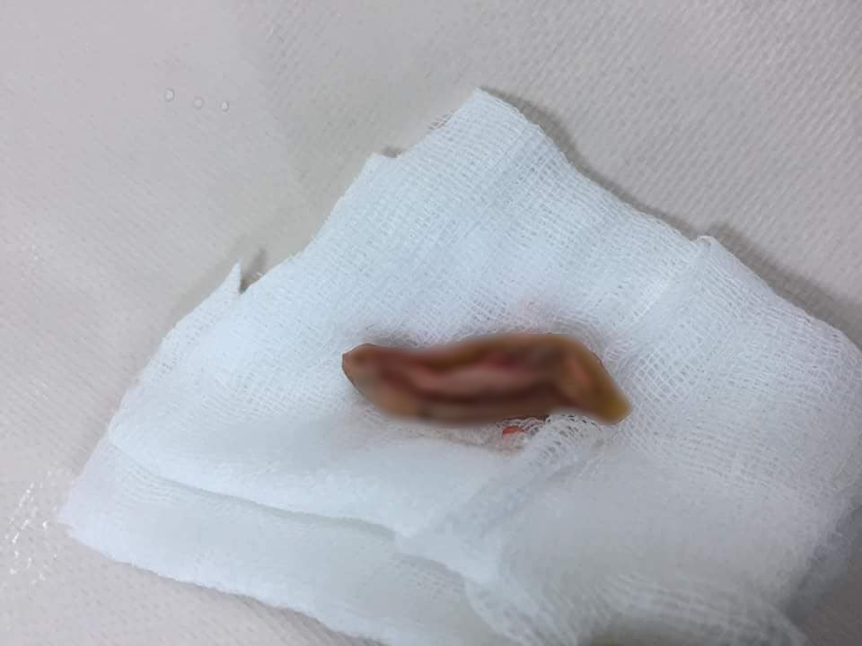 Nam sinh cắn đứt rồi nuốt tai của bạn vào bụng âm tính với ma túy?