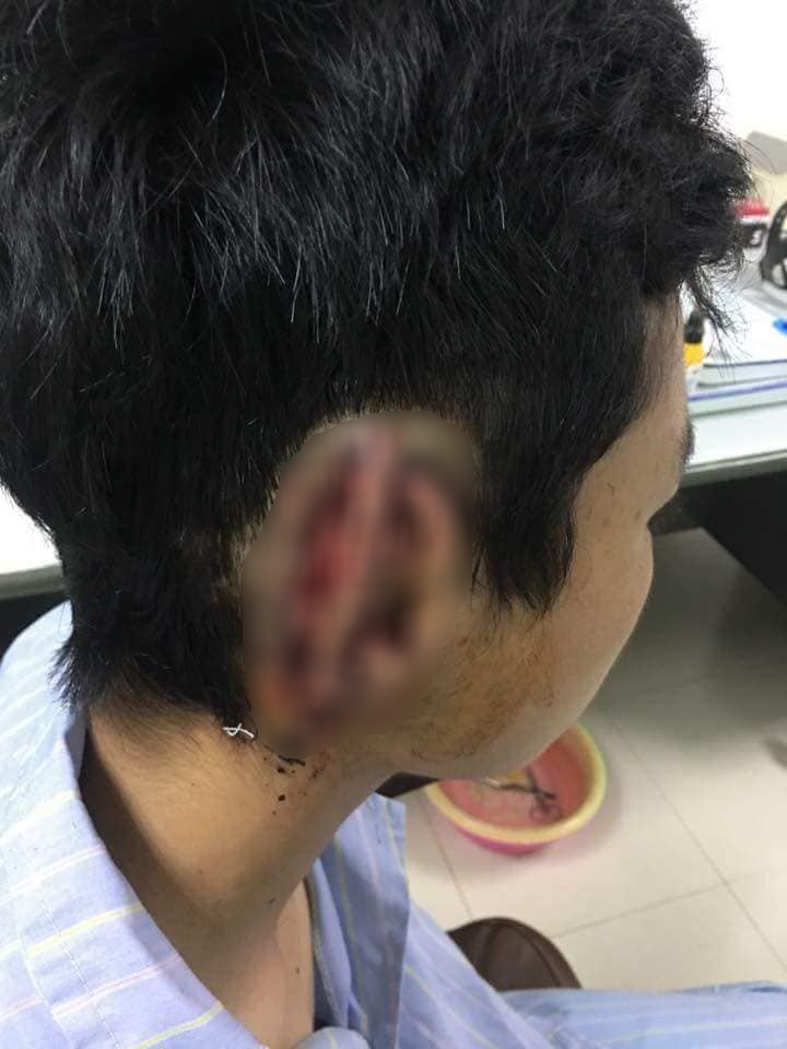 Nam sinh cắn đứt rồi nuốt tai của bạn vào bụng âm tính với ma túy?