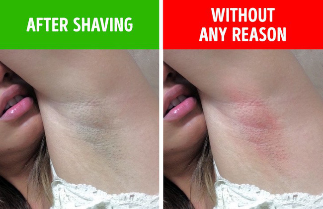 Đừng cố tình bỏ qua 6 biểu hiện ở nách vì nó có thể chỉ ra bệnh tiềm ẩn, không ngoại trừ ung thư