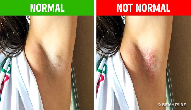 Đừng cố tình bỏ qua 6 biểu hiện ở nách vì nó có thể chỉ ra bệnh tiềm ẩn, không ngoại trừ ung thư