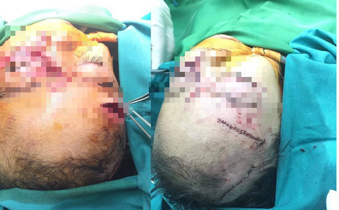 Bé 31 tháng tuổi bị chó nhà cắn nhiều nhát vào mặt, phải nhập viện cấp cứu