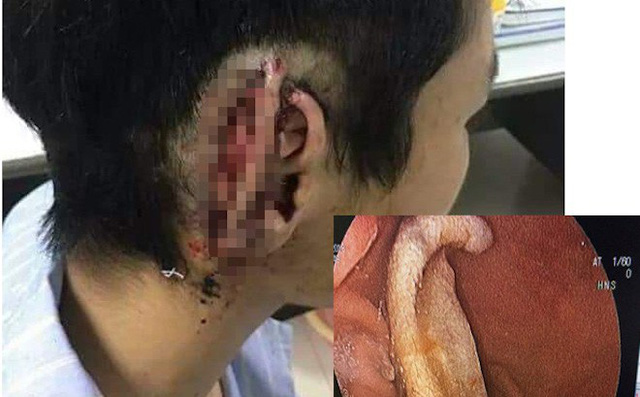 Công an vào cuộc vụ nam sinh cắn đứt tai bạn rồi nuốt luôn vào bụng