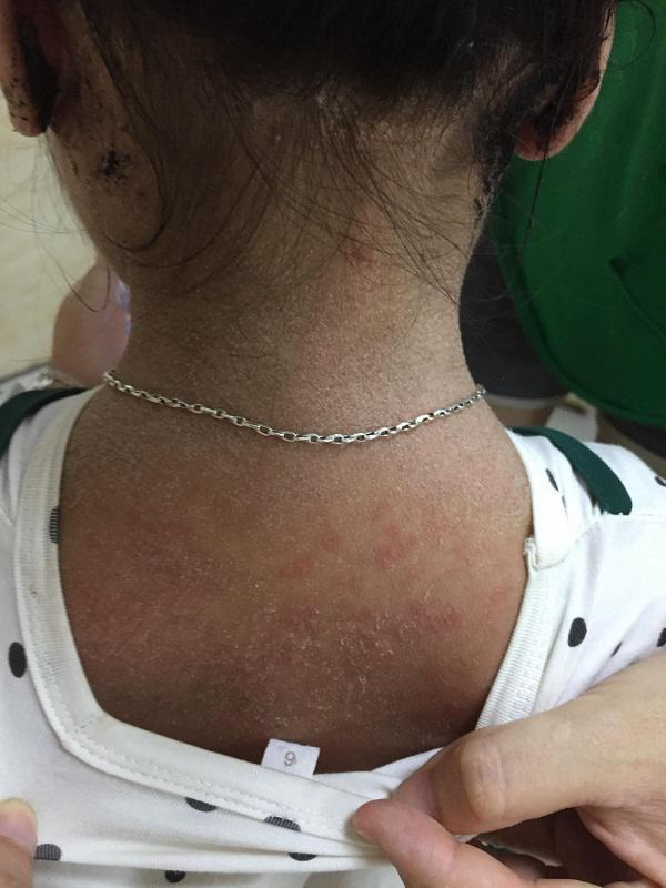 Nghĩ con cảm cúm mẹ tự mua thuốc cho uống, sau 4 ngày bé gái bong tróc da toàn thân