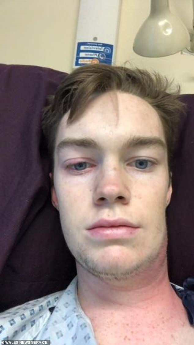 Nam sinh suýt mất mạng vì nặn mụn