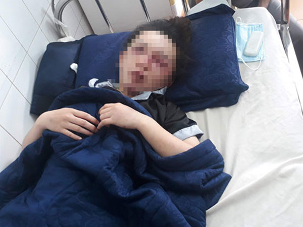 Nữ nhân viên spa bị đánh bầm mặt trong đêm