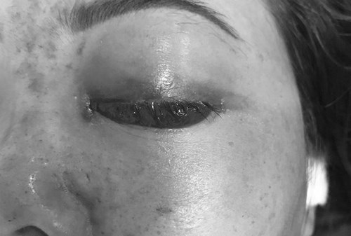 UBND TP.HCM đình chỉ 9 tháng, phạt 120 triệu đồng cơ sở spa khiến bệnh nhân mù mắt