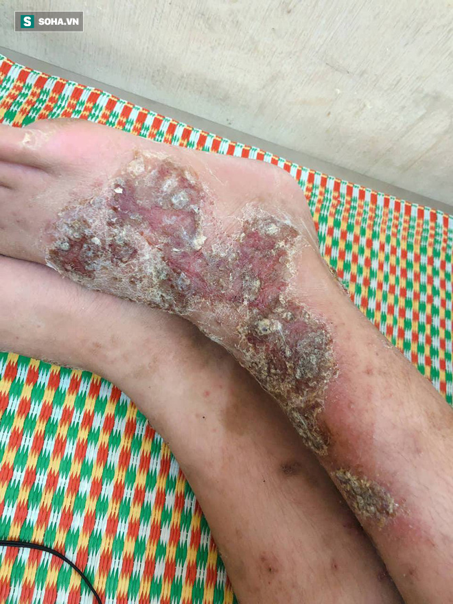 Thích ăn tiết canh, rau sống, nem chua, người đàn ông bị đau gan vì nguyên nhân không ngờ