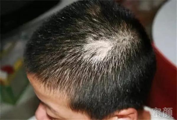 Con trai 3 tuổi đột nhiên bị rụng tóc, nguyên nhân thật sự khiến cha mẹ rất xấu hổ Con trai 3 tuổi đột nhiên bị rụng tóc, nguyên nhân thật sự khiến cha mẹ rất xấu hổ