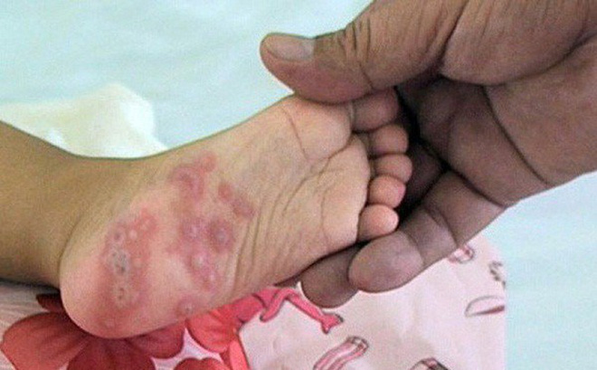 Tay chân miệng có thể biến chứng tử vong: BS bệnh viện Nhi khuyến cáo 4 việc cần làm ngay Tay chân miệng có thể biến chứng tử vong: BS bệnh viện Nhi khuyến cáo 4 việc cần làm ngay