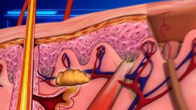 Tưởng chỉ là nốt mụn thông thường trên người con, mẹ suýt ngất khi nặn ra 4 con giòi sống