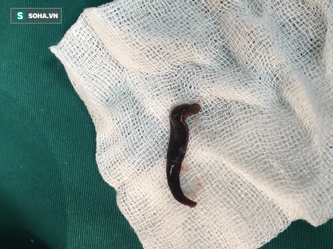 Sinh vật dài 5cm ngoe nguẩy trong mũi, khiến bệnh nhân đau đầu, sổ mũi kéo dài