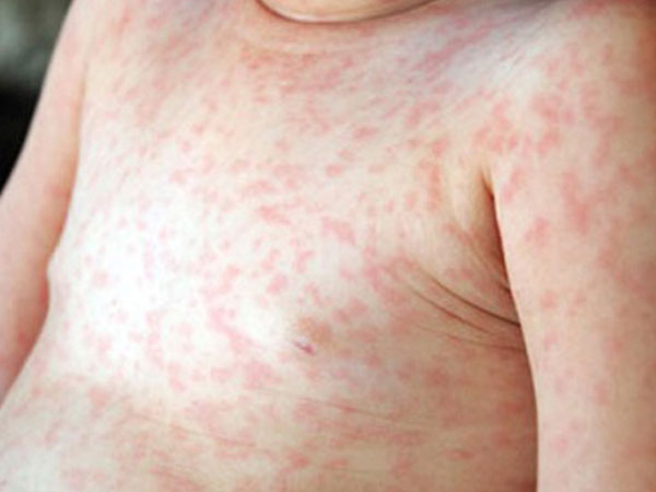 Thấy con bị sốt, nổi ban, mụn nước toàn thân, cha mẹ cần nghĩ ngay đến bệnh này