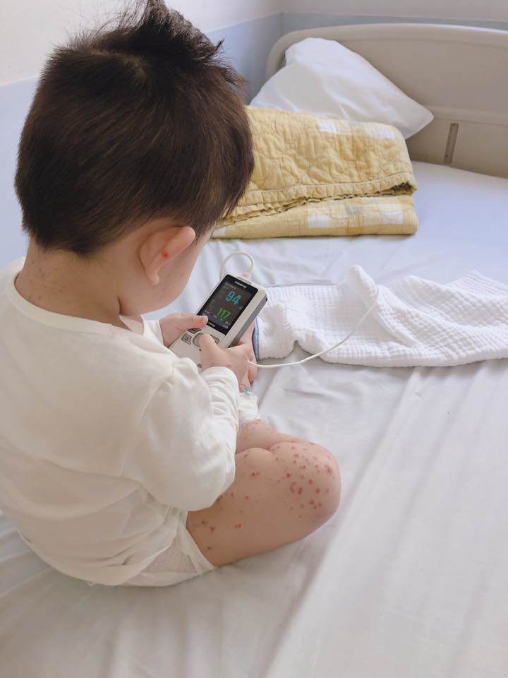 Ủ bệnh 10 ngày, bé trai 20 tháng được phát hiện mắc tay chân miệng nặng nhất bệnh viện