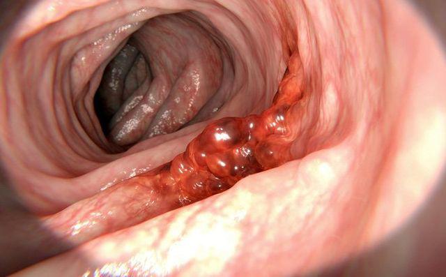 Người phụ nữ bị ung thư dạ dày giai đoạn cuối vì thói quen nấu nướng tai hại