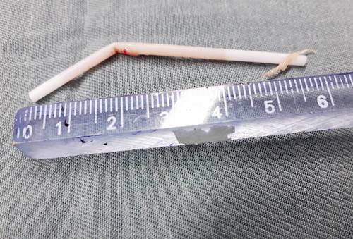 Người đàn ông nhét tăm bông ráy tai vào bàng quang