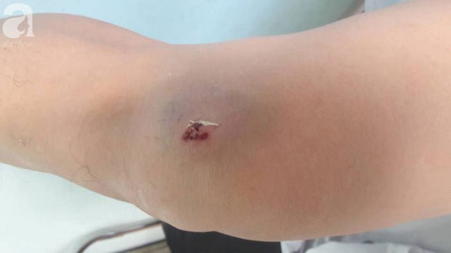 Hải Phòng: Người đàn ông kiệt quệ sau khi bị bạn gái thuê 5 côn đồ truy sát