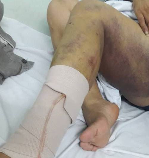 Hải Phòng: Người đàn ông kiệt quệ sau khi bị bạn gái thuê 5 côn đồ truy sát