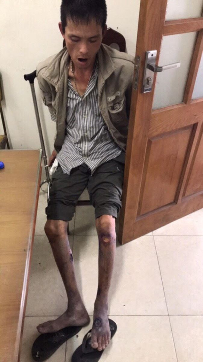 Nhiễm HIV giai đoạn cuối vẫn hành nghề bán ma túy cho con nghiện