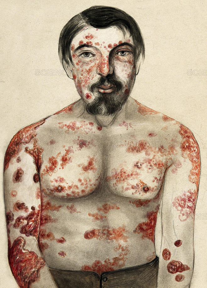 Giang mai - căn bệnh tàn phá hết sức kinh khủng bạn có thể gặp nếu sex không an toàn