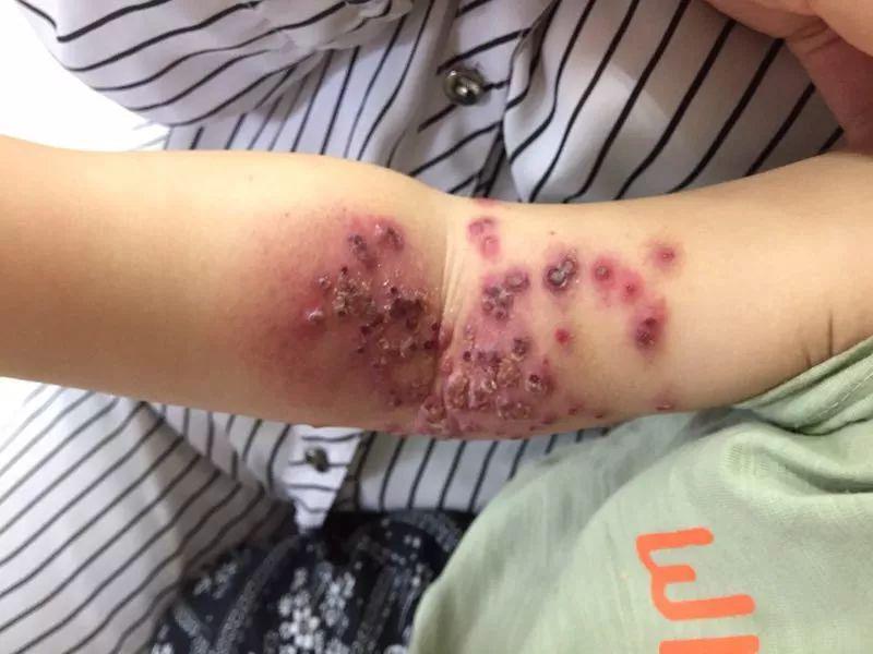 Cánh tay bé gái phủ đẩy nốt đỏ đáng sợ, mẹ nhớ lại hành động thường làm với con