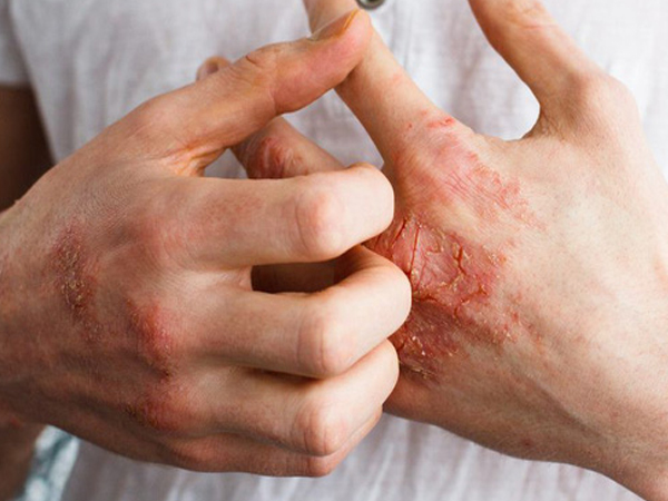 Tai họa đến từ cuộc sống hiện đại mang tên: Dị ứng thực phẩm