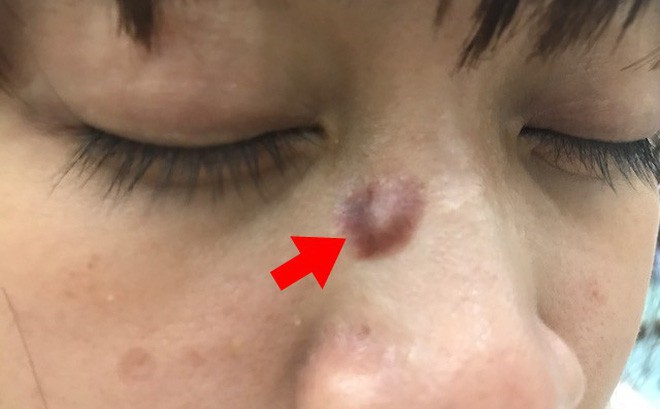 Ung thư từ nốt ruồi rất nguy hiểm, di căn nhanh: Những dấu hiệu của nốt ruồi cần cảnh giác