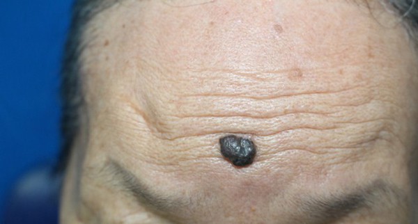 Ung thư từ nốt ruồi rất nguy hiểm, di căn nhanh: Những dấu hiệu của nốt ruồi cần cảnh giác